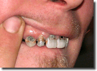 Meth Mouth