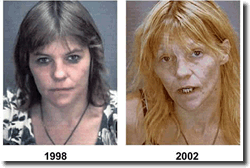 Meth User Before and After